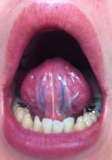 舌の裏側に青筋が浮かんでいるとお血(おけつ)の可能性があります