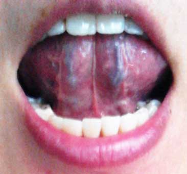 舌の裏側に青筋が盛り上がっているとお血(おけつ)の可能性が高いです