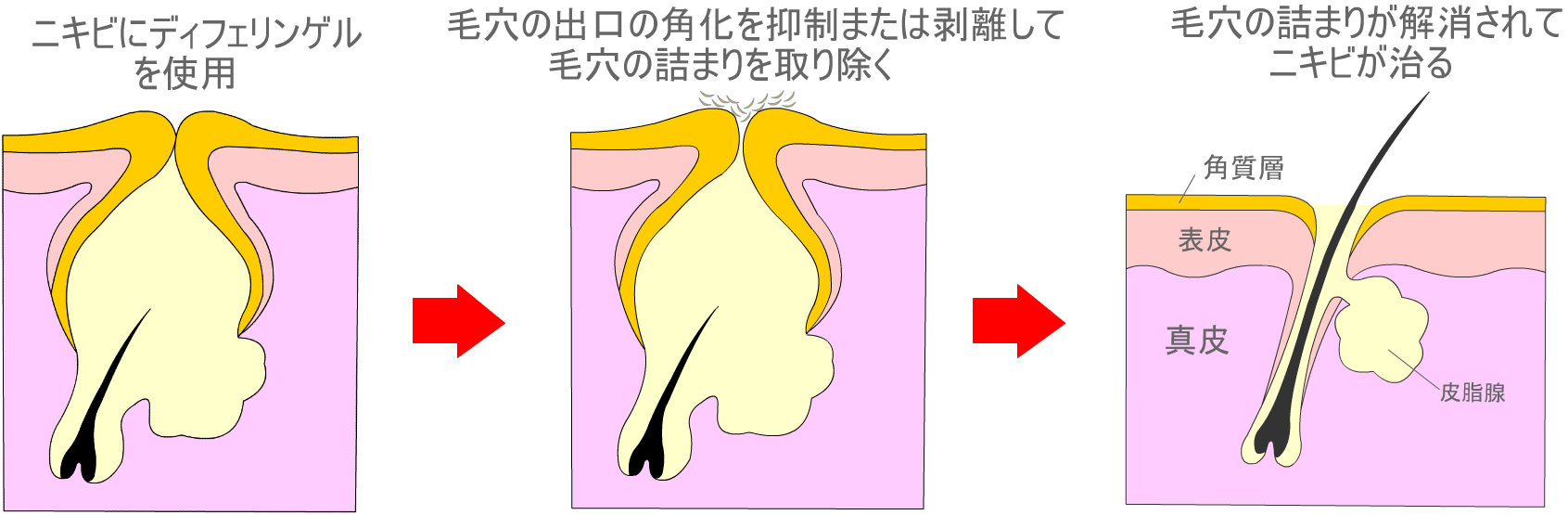 ディフェリンゲルのニキビに対する薬理作用