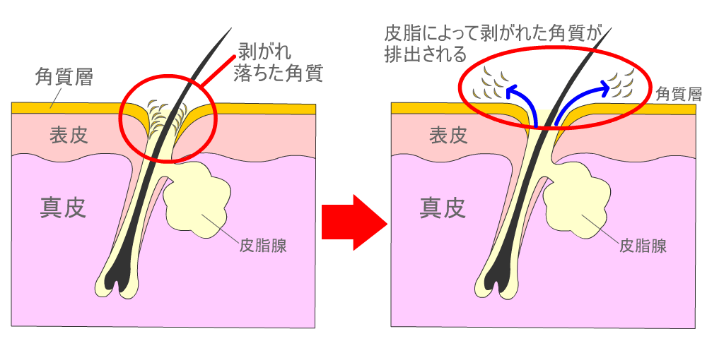 正常な肌は毛穴の出口の剥がれ落ちた角質が皮脂によって排出されます