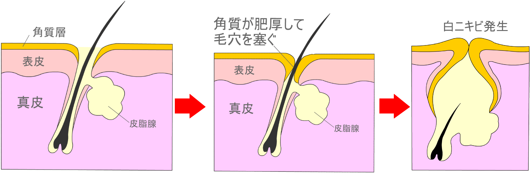 白ニキビ発生機序