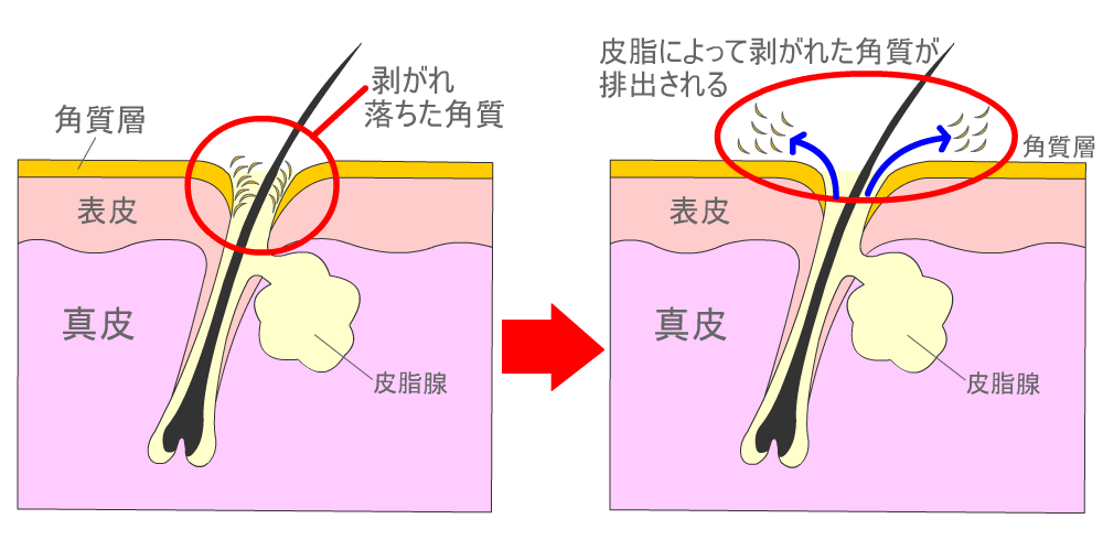 正常な肌状態はニキビが出来にくい