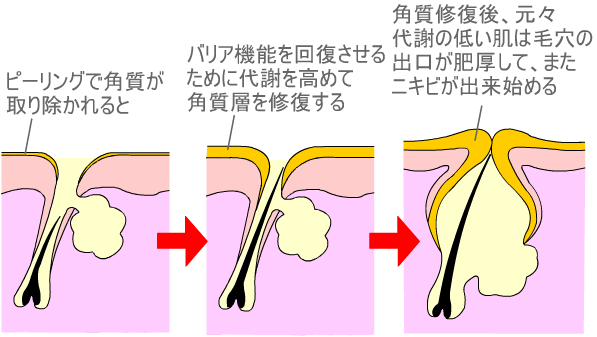 代謝の低下した肌では、ピーリング効果が薄れるとまたニキビを繰り返すようになる