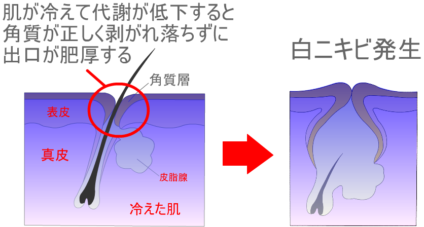 肌の冷えと白ニキビ