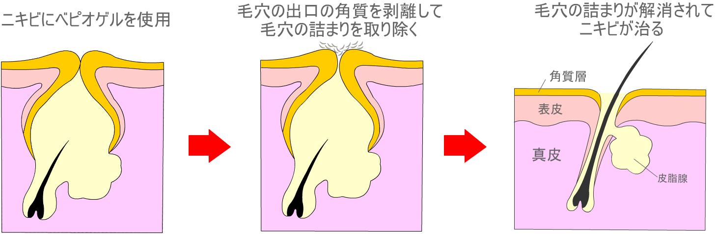 ベピオゲル作用機序