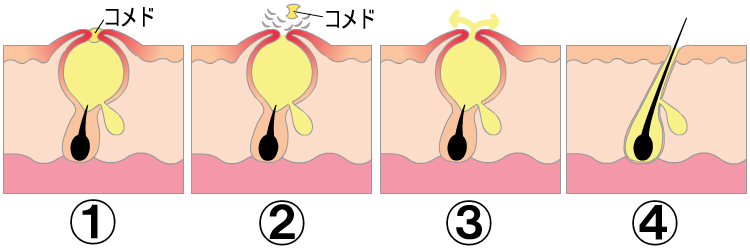 ニキビの部分の肌も代謝で入れ替わっているので代謝と共にニキビが治ります