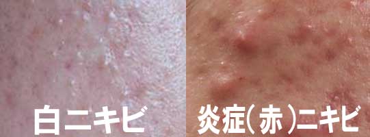 東洋医学では白ニキビに熱のこもりが加わると腫れて痛い赤ニキビに発展すると考えられている