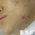 デュアックでも治らないニキビ・薬を塗ってもニキビが増えて悪化してしまう