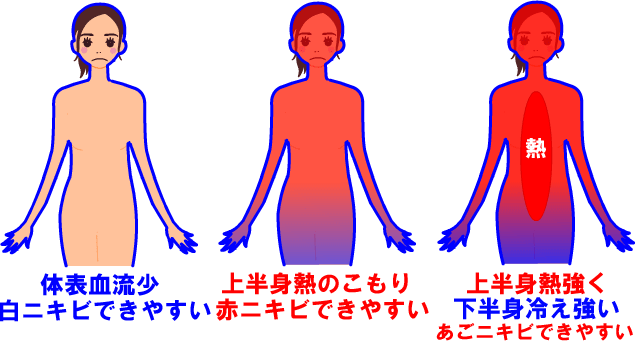 あごニキビができやすい体の状態