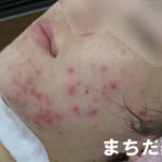 好転反応？ニキビを治す為のケアなのにニキビが悪化！