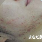 ニキビで皮膚科に行くべきか？ニキビをホントに治すには？