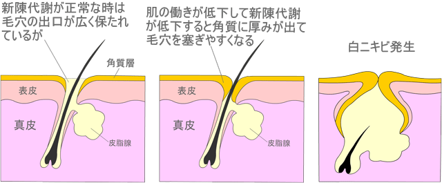 新陳代謝がスムーズにおこなわれず毛穴の出口の角質が肥厚すると白ニキビが出来やすくなります