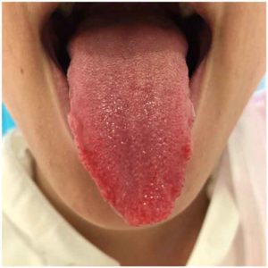 熱のこもりの巻意的判別法として、舌の赤みが強い人は熱のこもりも強いことが多いです